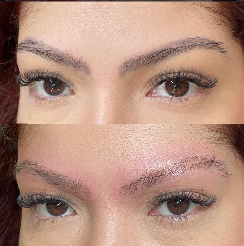 Sobrancelhas em evolução após despigmentação, preservando os pelos naturais.