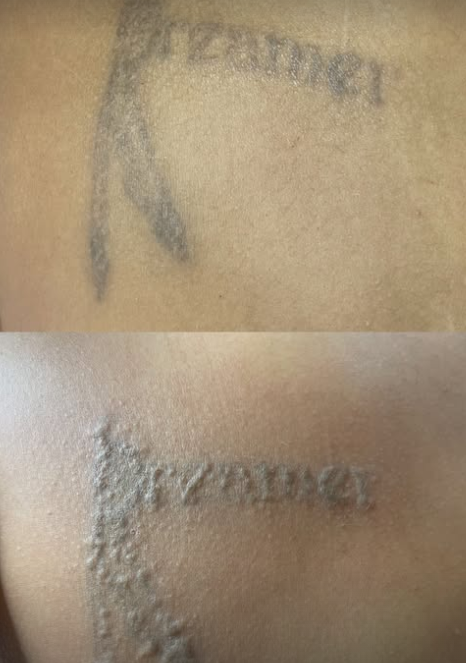Registro de pigmento de tatuagem durante o processo de remoção a laser.