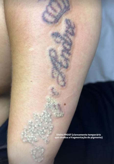 Tatuagem no braço com efeito frost temporário após aplicação do laser.